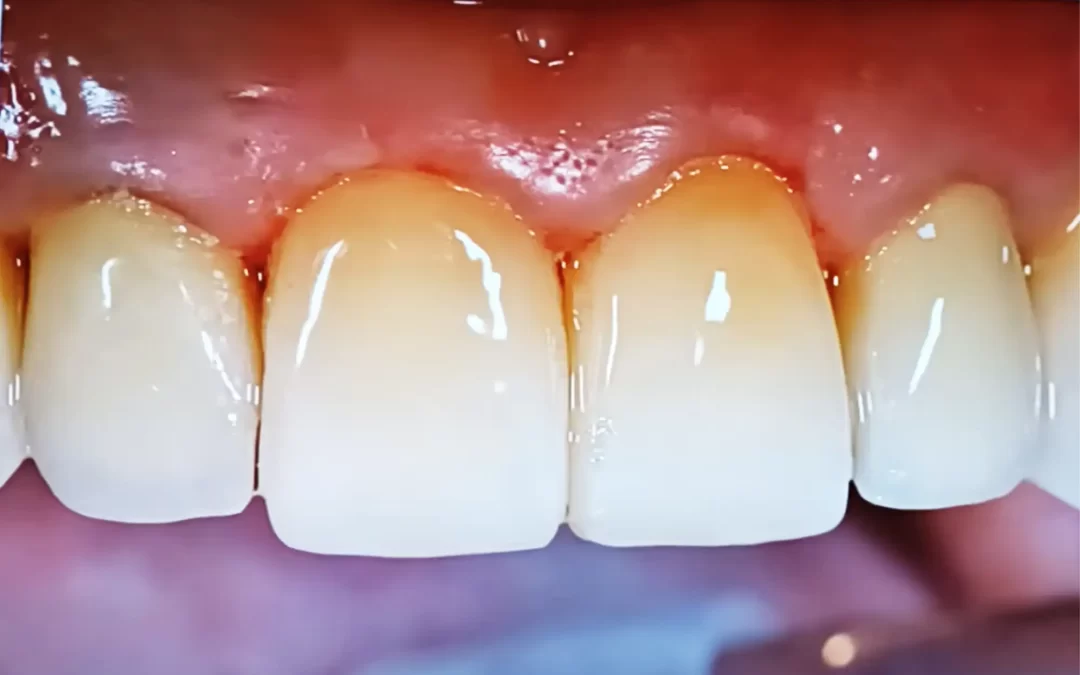 faccette dentali