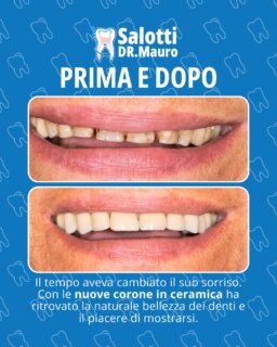 ✨ Un sorriso che torna a raccontare la sua storia.
La nostra paziente di 70 anni viveva da tempo con un sorriso compromesso: vecchie otturazioni pigmentate, usura dei margini incisali, denti piccoli, discromici e spaziati le avevano tolto espressività e sicurezza nelle relazioni sociali.

Con un trattamento mirato di corone in ceramica, abbiamo restituito armonia, nuova proporzione e un colore naturale ai suoi denti.
Il risultato? Un sorriso finalmente luminoso e autentico… e la gioia di mostrarlo di nuovo.

🦷 Studio Dentistico Mauro Salotti
La bellezza del sorriso non ha età.