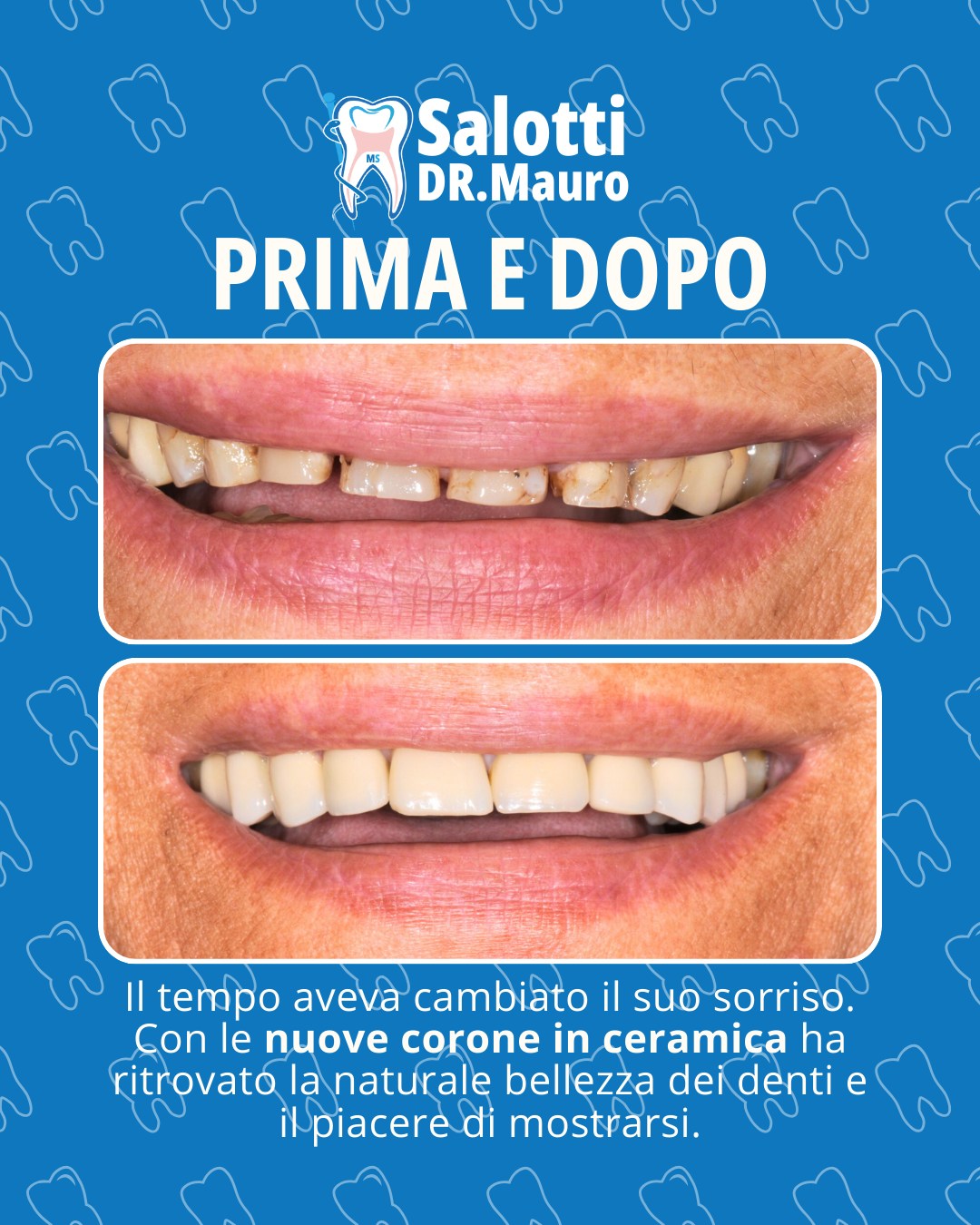 ✨ Un sorriso che torna a raccontare la sua storia.
La nostra paziente di 70 anni viveva da tempo con un sorriso compromesso: vecchie otturazioni pigmentate, usura dei margini incisali, denti piccoli, discromici e spaziati le avevano tolto espressività e sicurezza nelle relazioni sociali.

Con un trattamento mirato di corone in ceramica, abbiamo restituito armonia, nuova proporzione e un colore naturale ai suoi denti.
Il risultato? Un sorriso finalmente luminoso e autentico… e la gioia di mostrarlo di nuovo.

🦷 Studio Dentistico Mauro Salotti
La bellezza del sorriso non ha età.