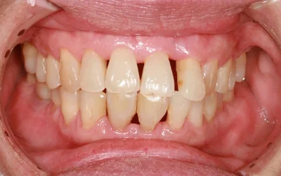 Denti lunghi e sorriso inestetico? Cause e rimedi | Studio dentistico San Benedetto