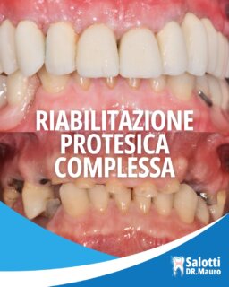 ✨ **Ogni sorriso racconta una storia. Questa è una storia di rinascita.**

In questo caso, un paziente di 60 anni presentava un sorriso compromesso da **fratture dentali, carie e una grave perdita dell'armonia estetica**.

Attraverso una **riabilitazione protesica complessa** con **corone in zirconia-ceramica**, è stato possibile ricostruire non solo l'estetica del sorriso, ma anche la funzionalità masticatoria e il benessere del paziente.

Il risultato è un sorriso:
🦷 naturale
🦷 armonioso
🦷 resistente
🦷 progettato per durare nel tempo

Ogni riabilitazione è unica e viene studiata su misura, perché il nostro obiettivo non è solo ricostruire i denti, ma restituire sicurezza, comfort e qualità della vita.

📩 Se anche tu desideri ritrovare il piacere di sorridere, contattaci per una consulenza personalizzata.

#trasformazionesorriso #riabilitazioneprotesica #protesidentale #coroneinzirconia #esteticadentale #dentista #odontoiatria #sorriso #saluteorale #implantologia #sanbenedettodeltronto