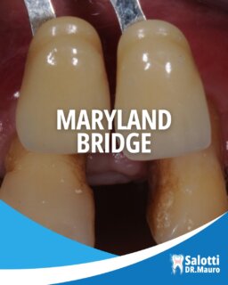 🦷 Quando manca un dente, anche una soluzione provvisoria può fare la differenza.
In questo caso, la perdita dell’incisivo laterale superiore sinistro, estratto a causa di una grave compromissione parodontale, aveva creato un evidente disagio estetico.
In attesa della guarigione dei tessuti e della successiva valutazione della soluzione implantare definitiva, è stato scelto un Maryland Bridge, un dispositivo protesico con aletta ad adesione.
✨ Il risultato? Una soluzione immediata, conservativa e dall’ottimo impatto estetico, capace di restituire al paziente la naturalezza del sorriso durante la fase di guarigione.
Il Maryland Bridge può rappresentare, in casi selezionati, una valida soluzione temporanea in attesa del trattamento definitivo.
📩 Ogni situazione va valutata individualmente: se hai perso un dente e vuoi conoscere le possibili soluzioni, contattaci per una consulenza.
#marylandbridge #protesidentale #dente #sorriso #trasformazionesorriso #esteticadentale #odontoiatria #protesi #implantologia #saluteorale #dentista #sanbenedettodeltronto